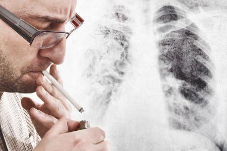 Cancer du poumon : vers un dépistage systématique 