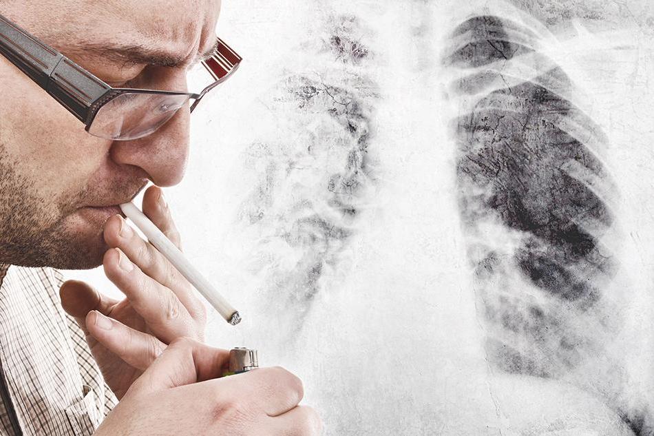 Cancer du poumon : vers un dépistage systématique 