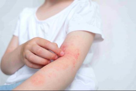 Des progrès dans la prise en charge de la dermatit