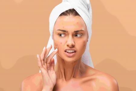 Et si on soignait l’acné par le microbiome ?