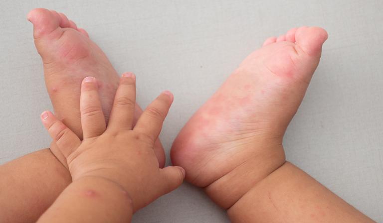 Image - Le syndrome pieds-main-bouche