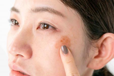 Peut-on enlever les taches brunes de la peau ?